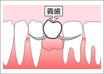 部分入れ歯