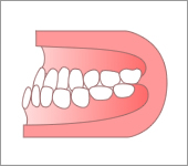 反対咬合（受け口）
