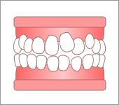 叢生（八重歯・乱ぐい歯）